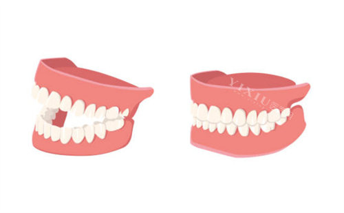 假牙示意图