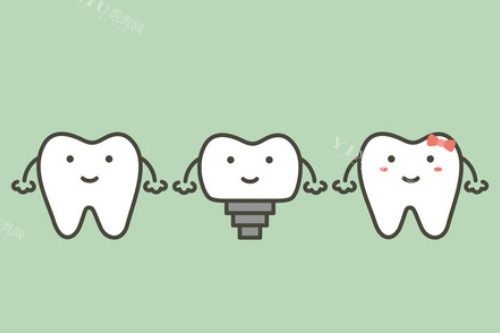 单颗种植牙卡通展示图