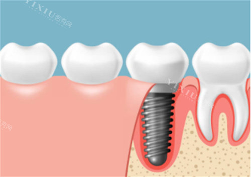 种植牙在口腔剖面图