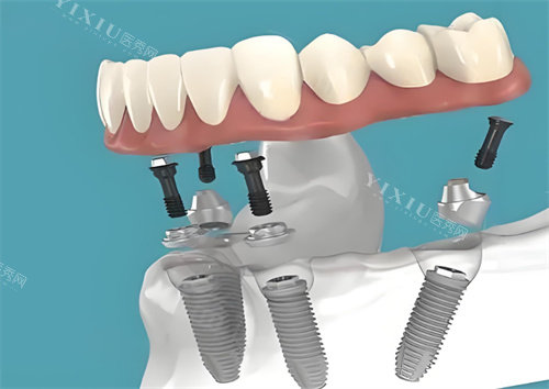 种植牙图片展示图