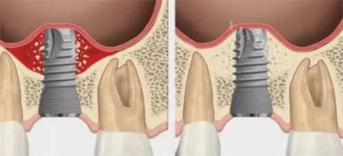上颌窦穿孔演示图