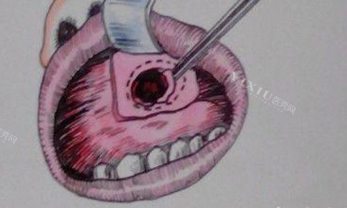 上颌窦穿孔的动画图