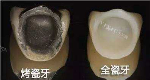 烤瓷牙和全瓷牙展示图