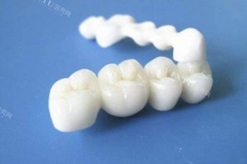 全瓷牙冠模型一览图