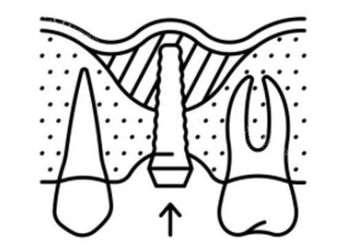 上颌窦种植牙简笔图