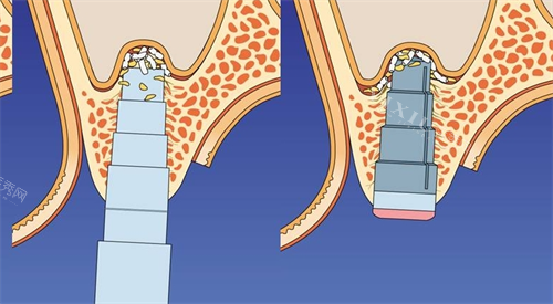 上颌窦提升示意图