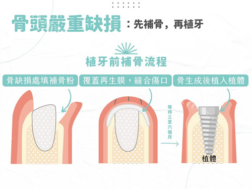种植牙植骨与植体植入过程漫画图