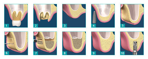 牙科植骨步骤照片
