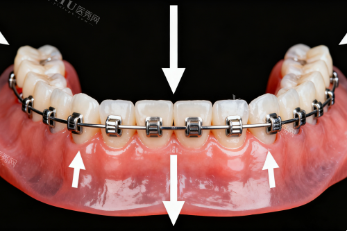 传统金属矫正器展示