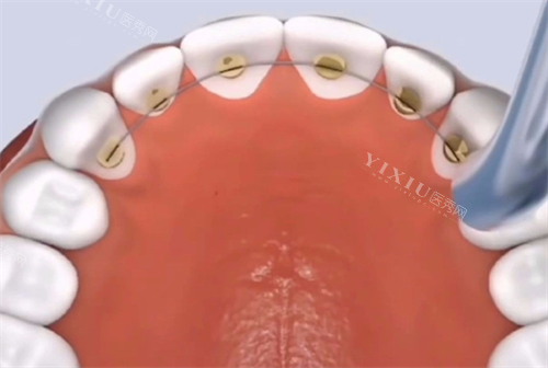 舌侧矫正动画模拟