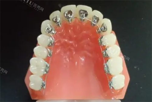 舌侧矫正假牙模拟展示