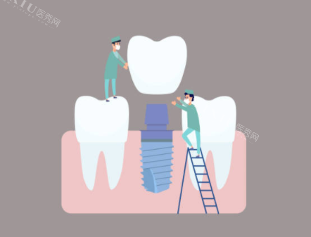 种植牙检查示意图