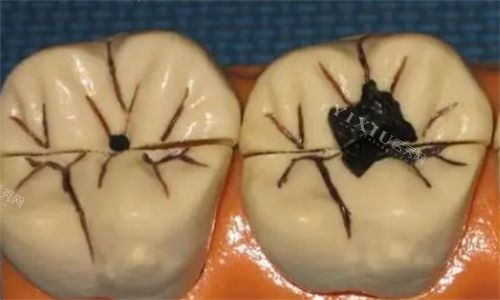 龋齿牙齿模型展示