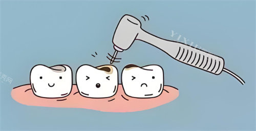 龋齿治疗动画展示图