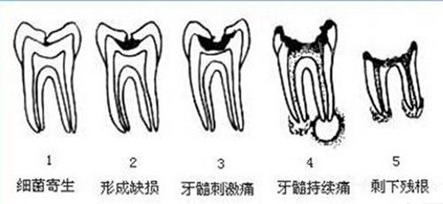 龋齿一度到五度图片