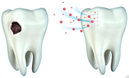 牙齿牙釉质龋坏和正常牙釉质