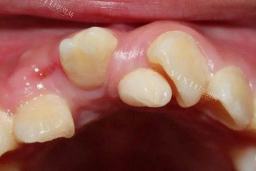 牙齿畸形问题模型图