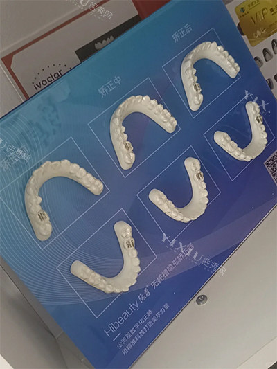 隐秀隐形牙齿矫正