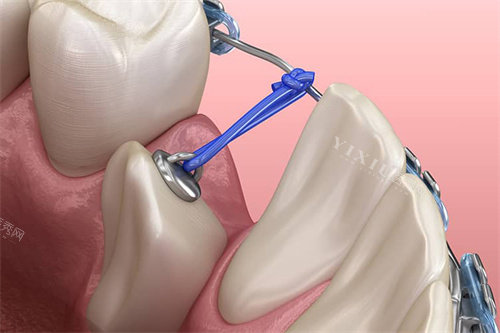 下颌单颗牙齿牵引
