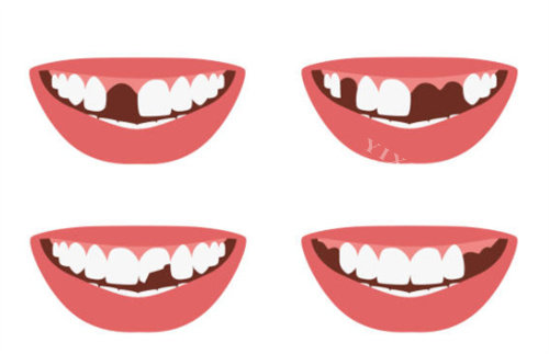 牙齿缺失图