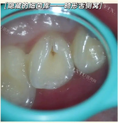 畸形舌侧窝牙齿展示图