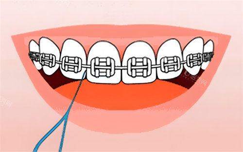 金属牙齿矫正卡通图片