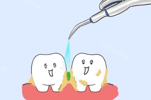 牙齿清洁展示图