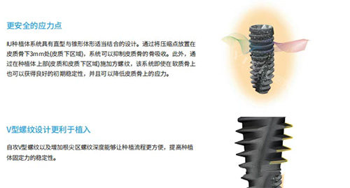 韩国沃兰种植牙优势图片