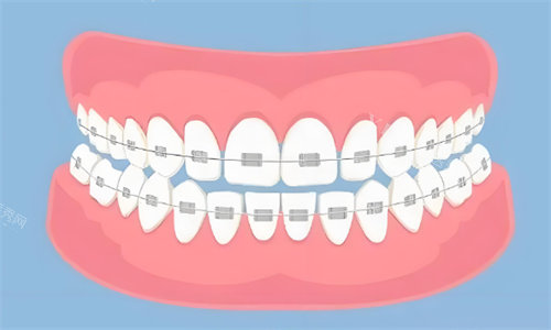 金属矫正牙齿