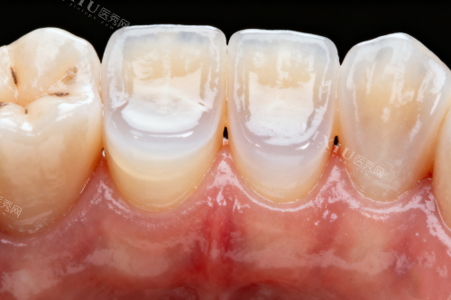 长春嘉盛口腔怎么样？高难度种植技术 + 隐形矫正成效显著，价格还亲民！(图7)