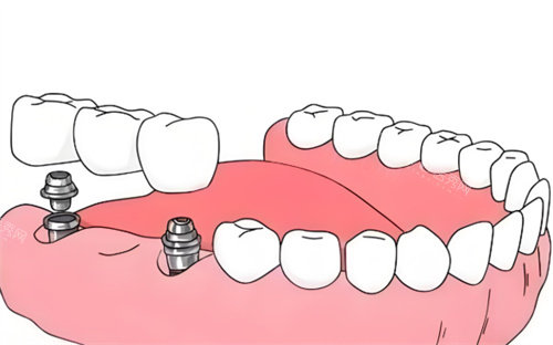 种植牙材料卡通展示图