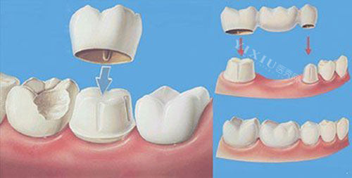 假牙带牙冠过程示意图