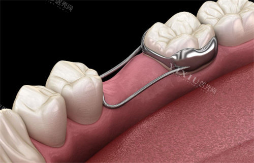 牙齿间隙保持器