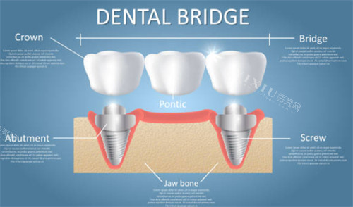 种植牙连桥冠示意图