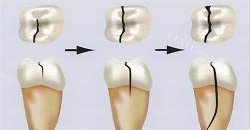 牙齿裂纹的发展过程