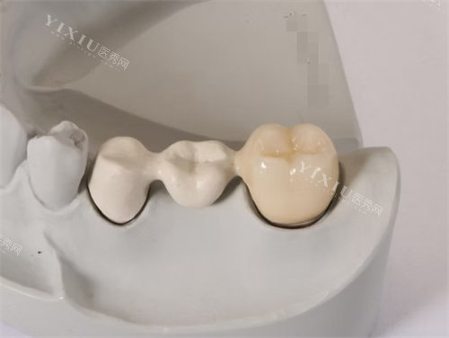 peek支架定制假牙