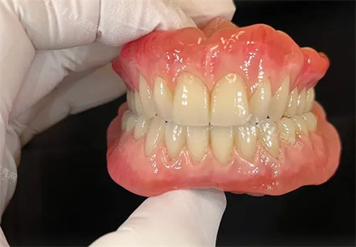 成品吸附性义齿