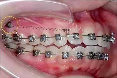 牙齿矫正骨钉种植钉2