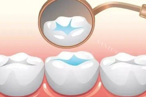 儿牙窝沟封闭卡通图