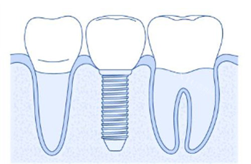 简单种植牙背景图
