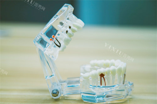 根管治疗牙齿模型
