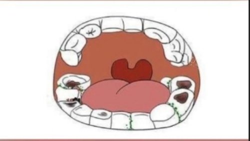 牙齿腐蚀漫画示意图