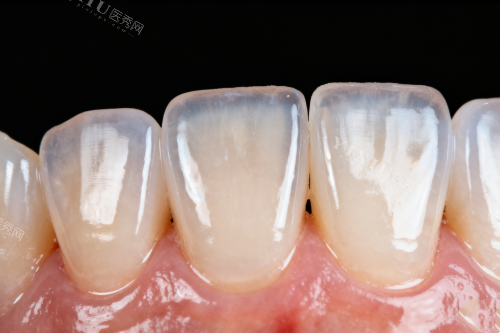 牙齿发黄卡通展示图