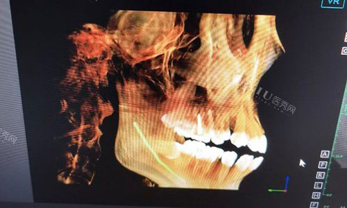 金华东阳马爽口腔牙齿拍片示意图