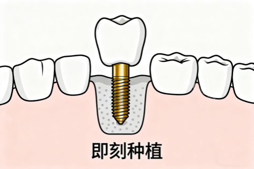 牙齿即刻种植卡通图