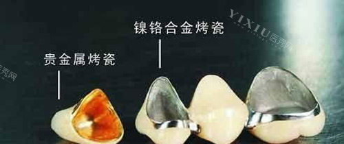 烤瓷牙不同材料示意图