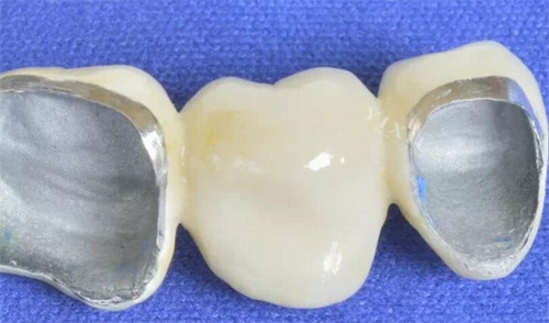 烤瓷牙模型展示图