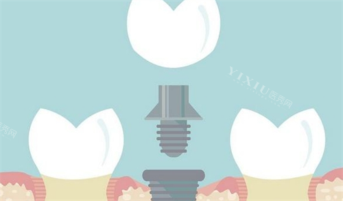 组成种植牙的三部分动画展示