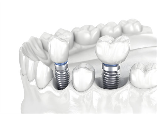 种植牙图片模型