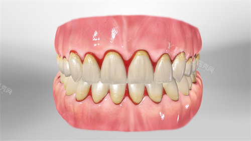 牙齿根部牙龈出血